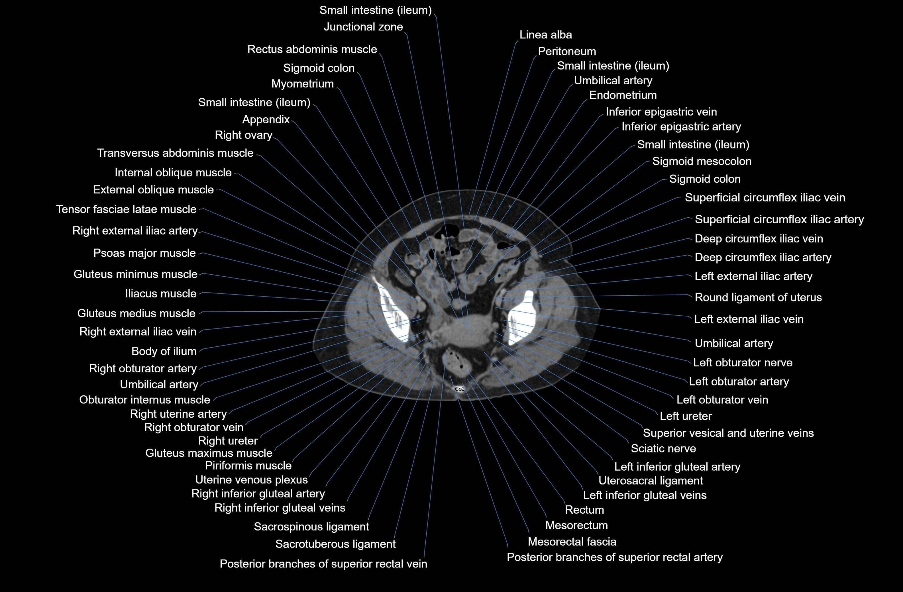 CT Abdomen axial cross sectional anatomy labelled radiology image-00084.webp
